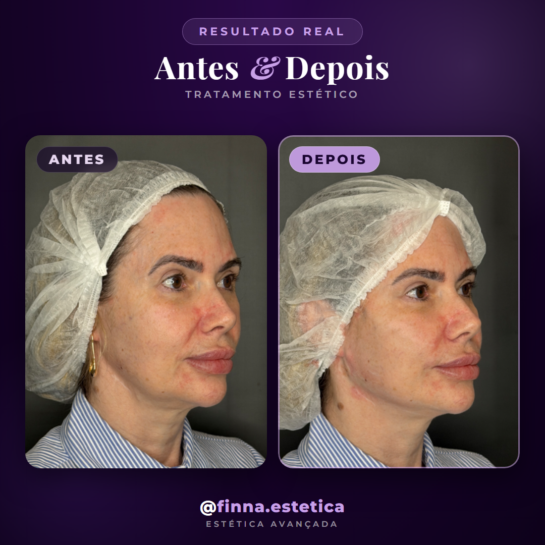 Antes e depois fios de pdo