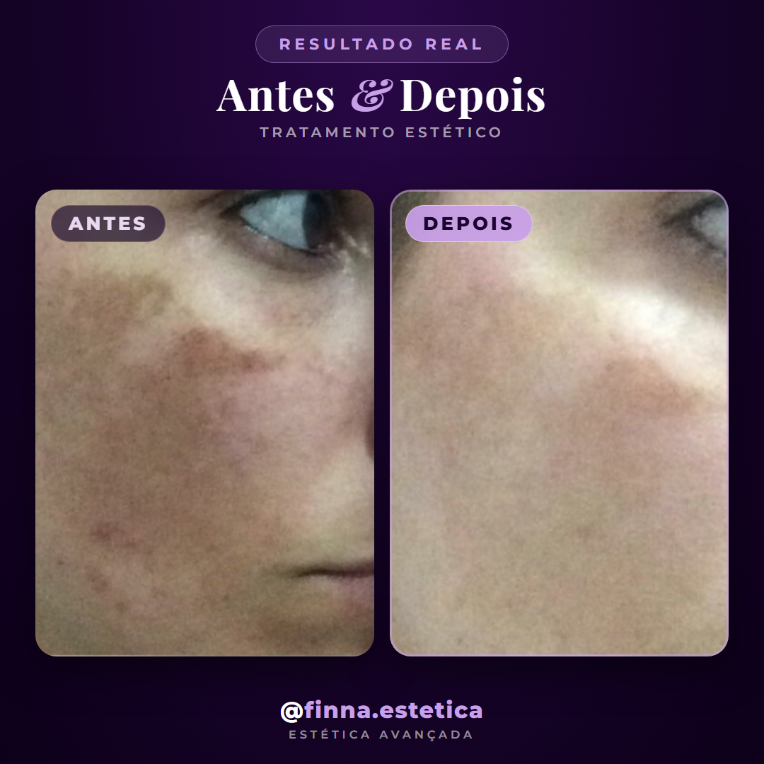 Antes e depois tratamento de manchas