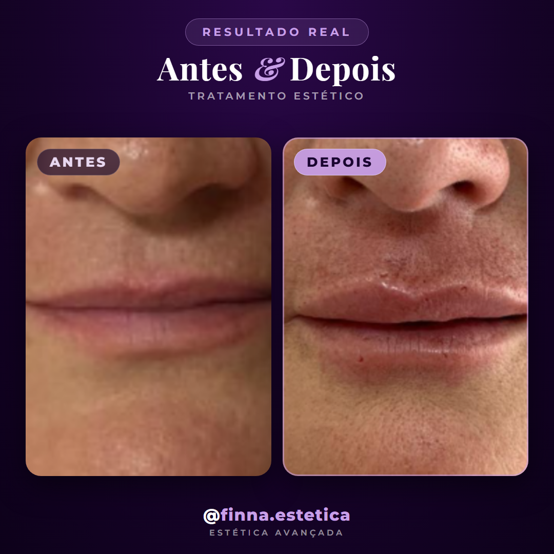Antes e depois preenchimento labial