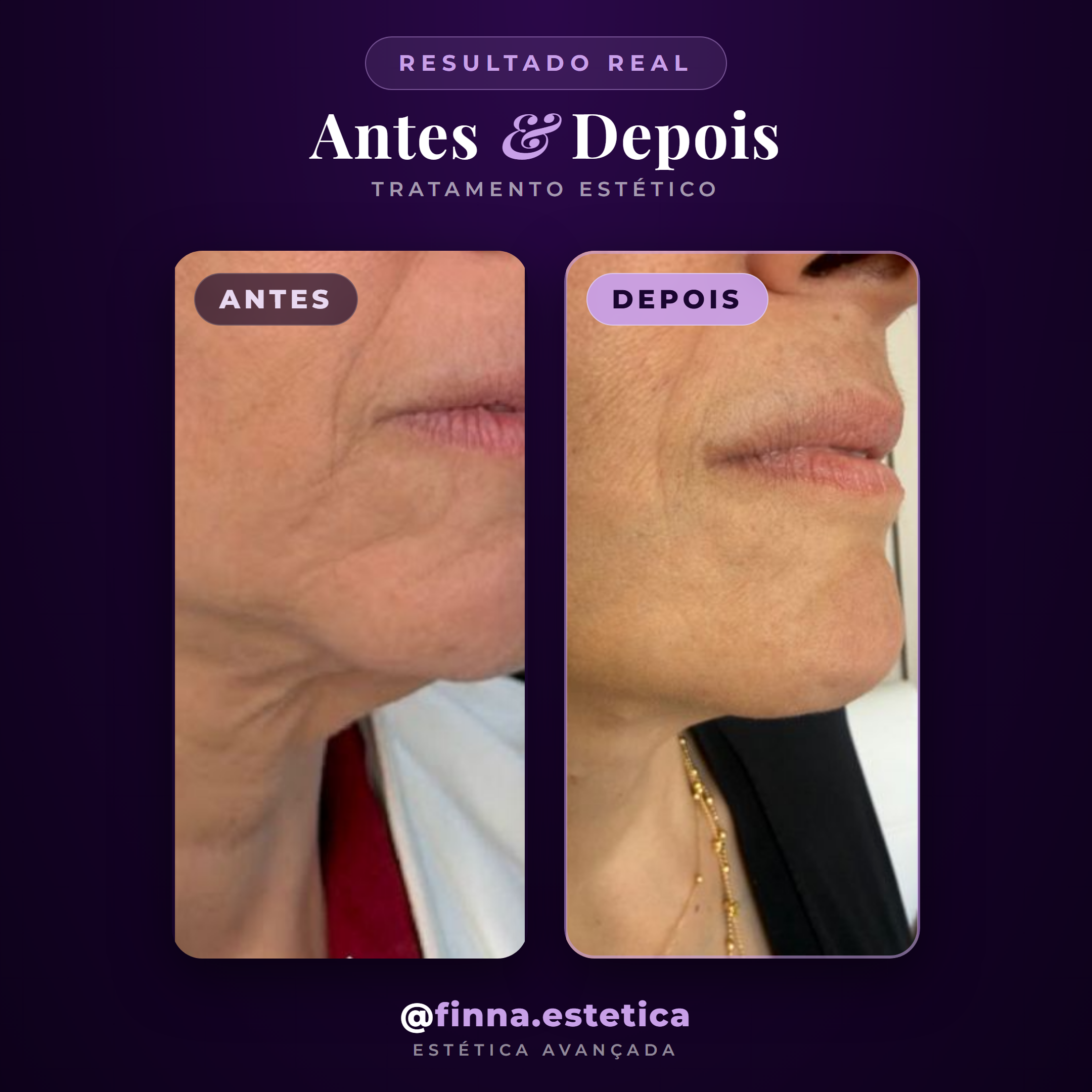 Resultado real Finna — antes e depois